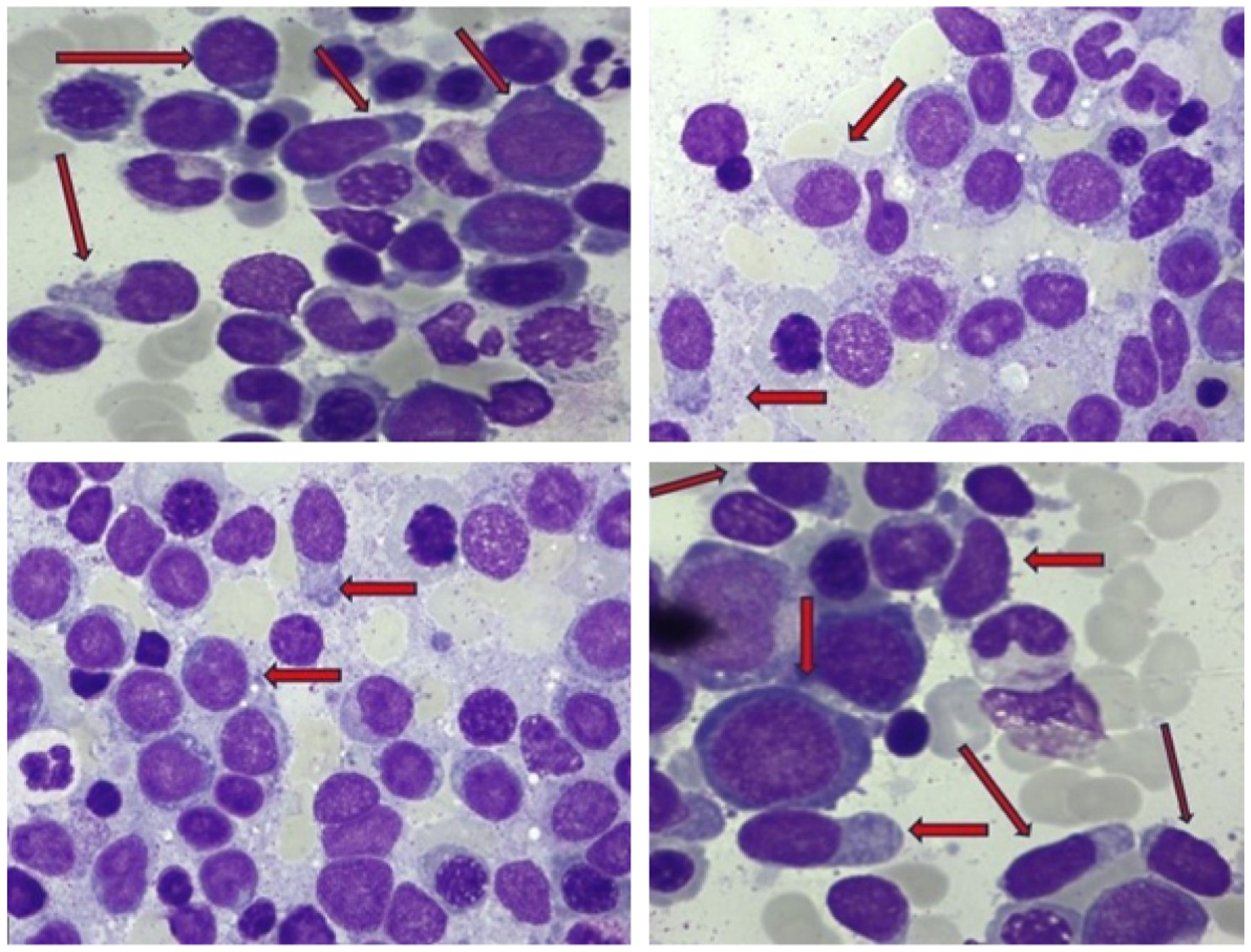 Efficacy and Long-Term Remission Following Haploidentical HSCT for