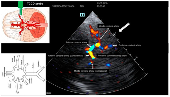 Point-of-Care Transcranial Doppler Sonography at the Intensive