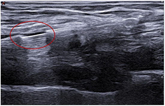 Ellipsys Endovascular Creation of Native Arteriovenous Fistulas for Hemodialysis ...