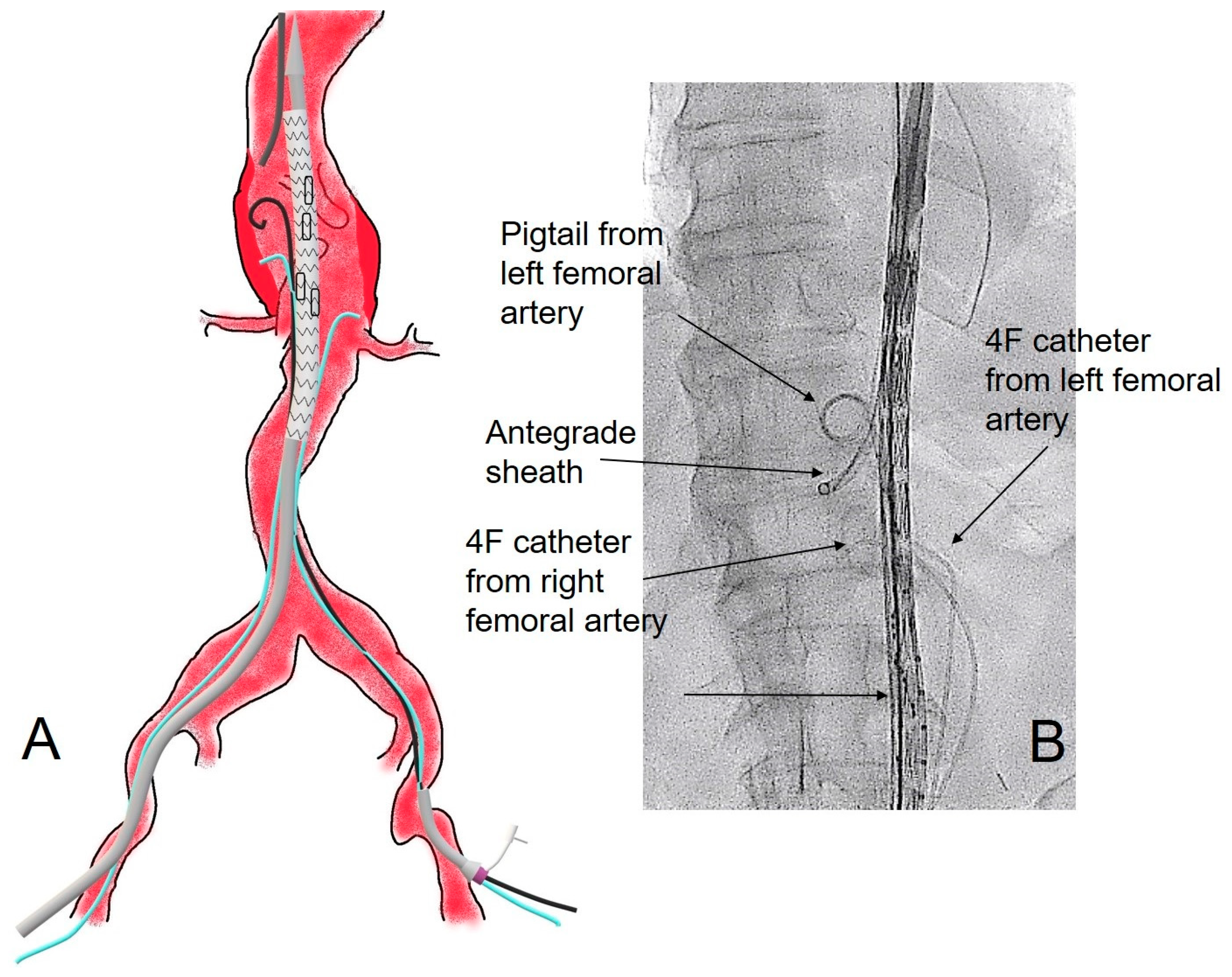 Femoral Sheath Catheter Femoral Sheath Catheter