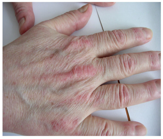 dermatomyositis glutathione The Spectrum of Cutaneous Manifestations in Dermatomyositis: A Comprehensive Review Cuproplasia and cuproptosis, two
