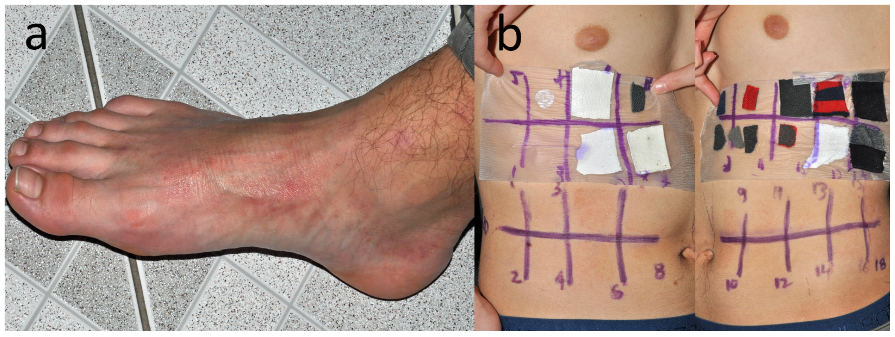 Webbing Rash Oxulate Patch Testing with Disperse Blue Mix and Textile Dye Mix in Textile ...