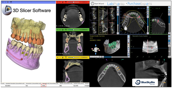 Digitally Guided Hybrid Maxillary Expansion with Supragingival