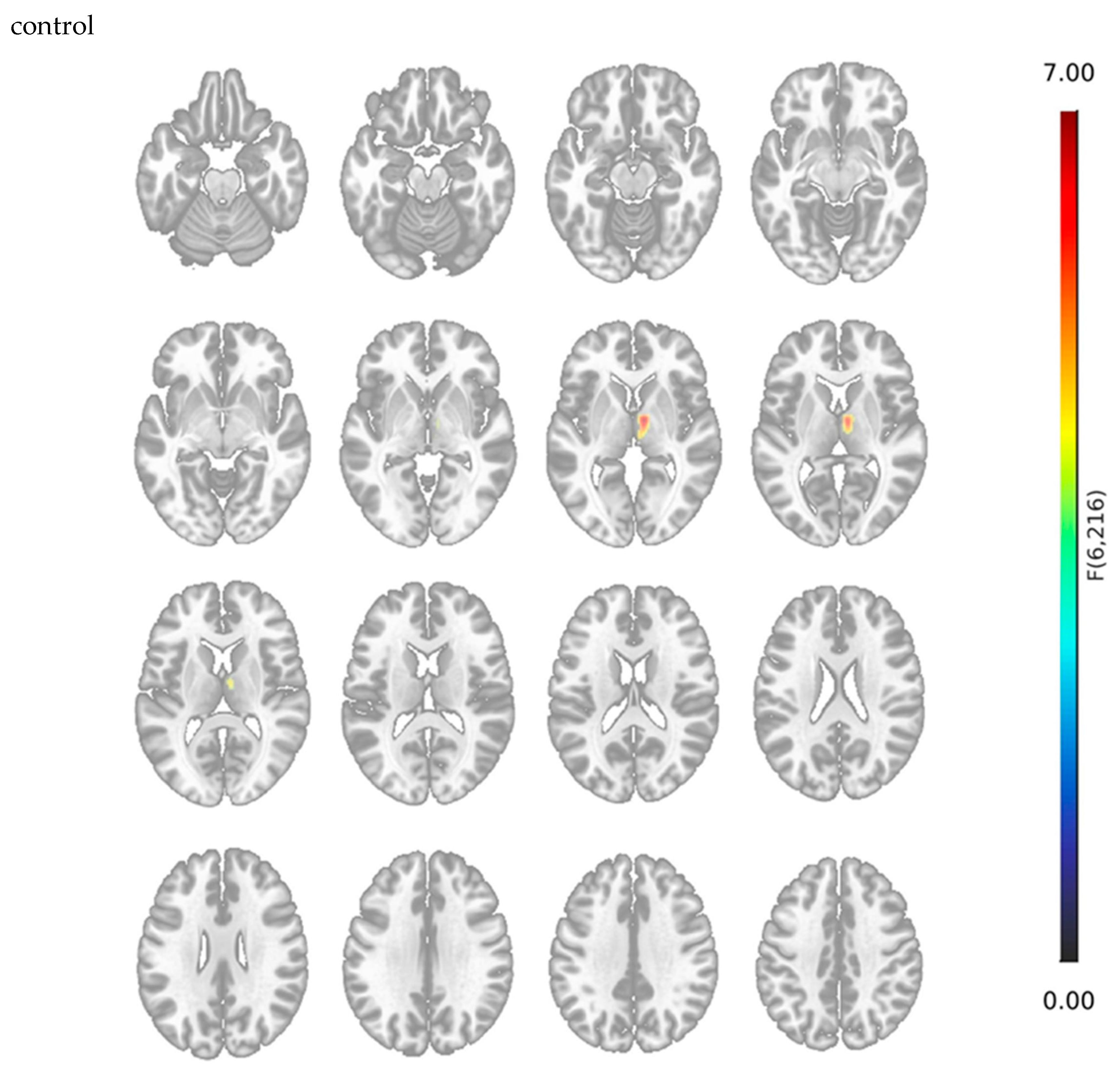 Assessing the Relationship Between Volumetric Changes and