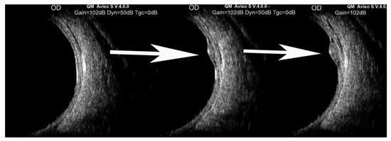 Vortex Varix Varicosity of Vortex Vein Ampulla in Ocular Fundus: Descriptive Series ...