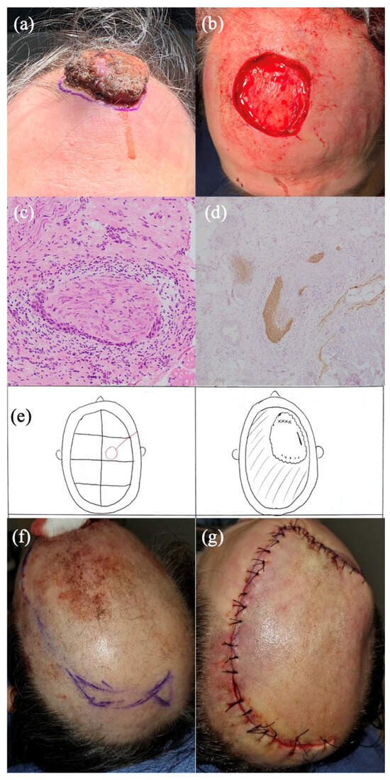 melanotic stool icd 9 Melena, Causes, Signs and Symptoms, Diagnosis and Treatment