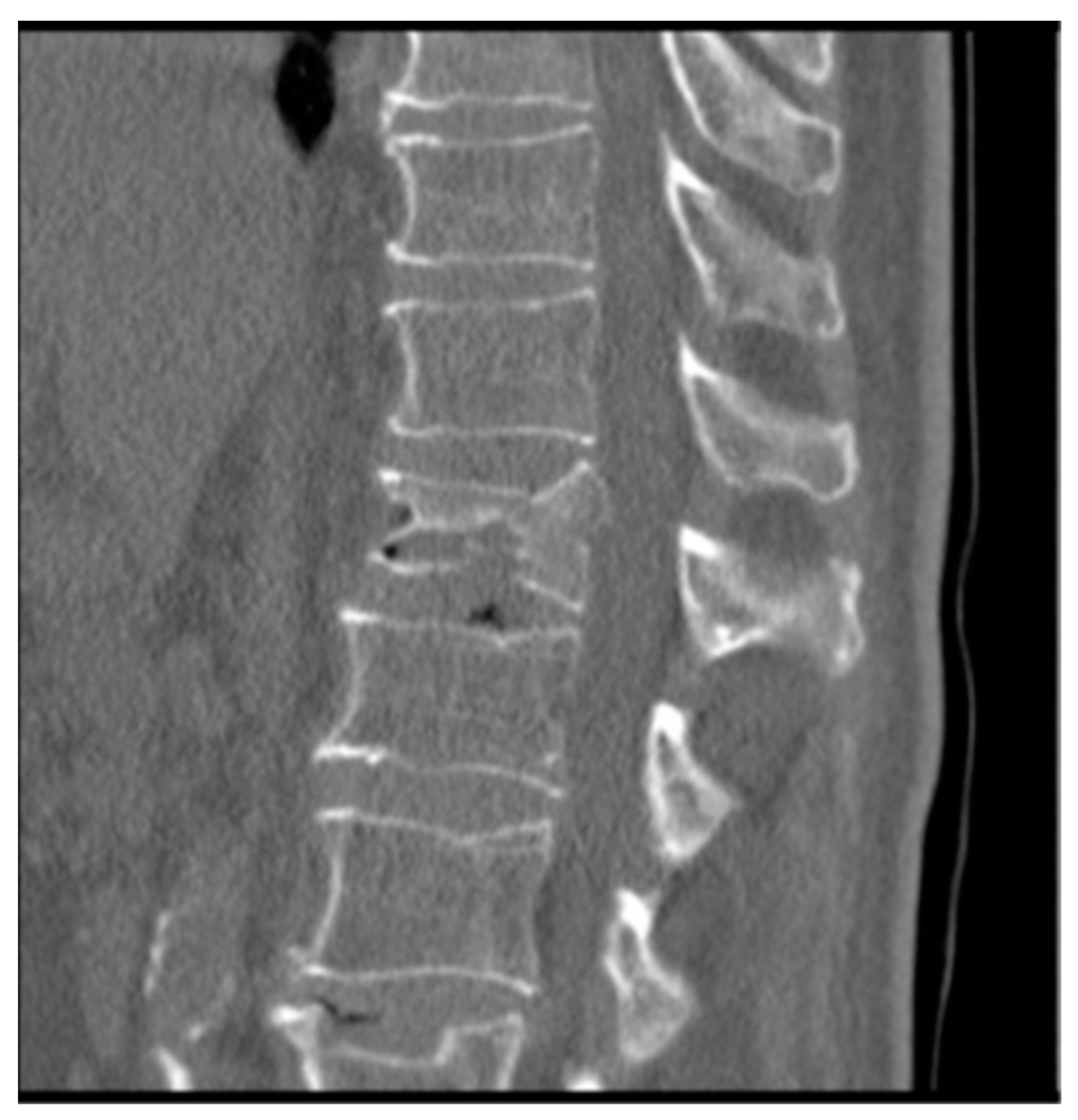 JFB Free FullText Restoration in Vertebral Compression Fractures