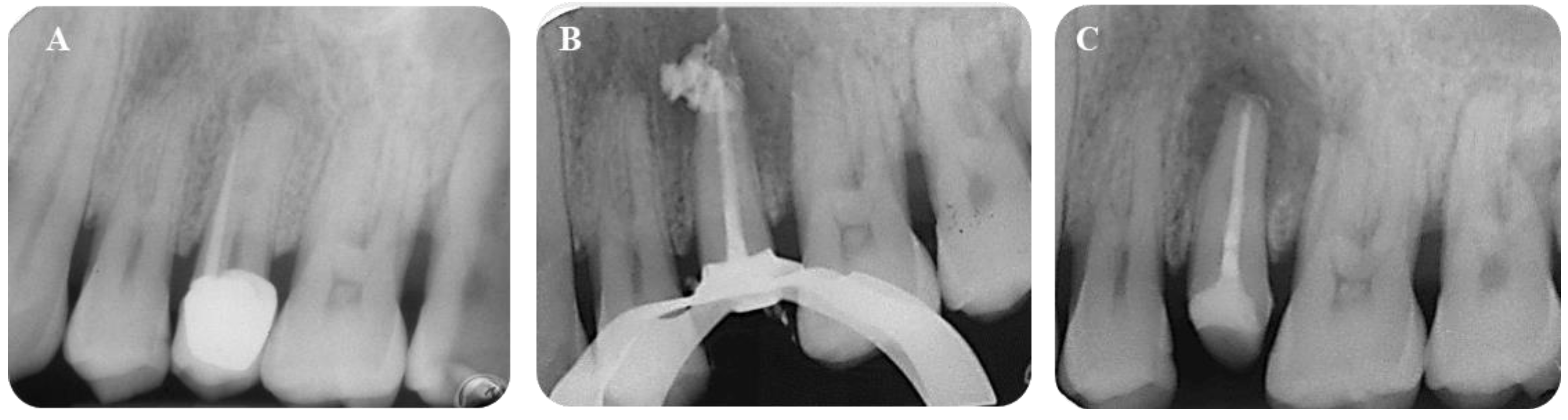 JFB Free FullText The Use of Premixed Calcium Silicate Bioceramic