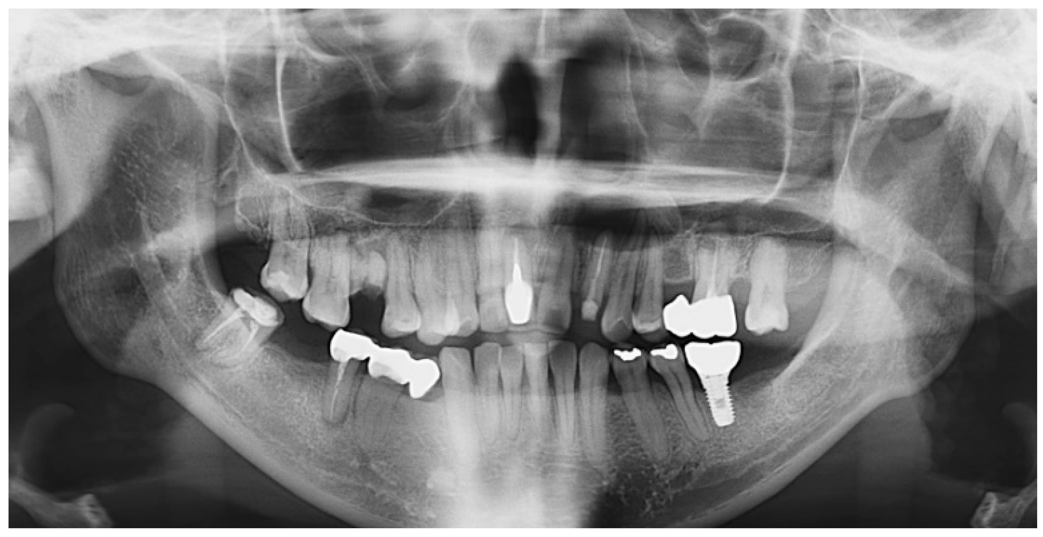 JFB Free FullText Incorporating Moldable Demineralized Dentin