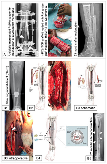 Bone lengthening using the Fitbone® motorized intramedullary nail: The  first experience in France - ScienceDirect