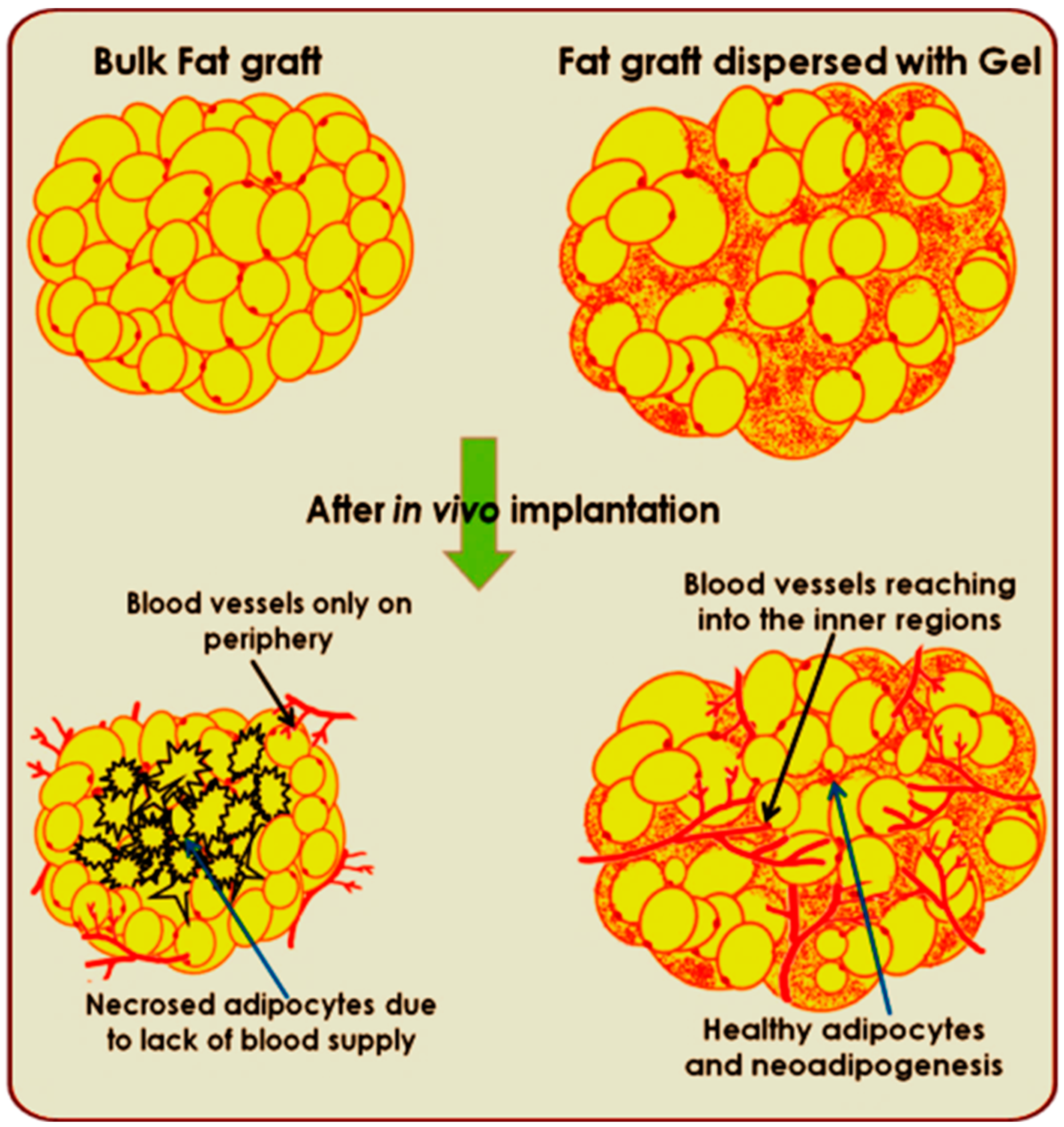 JFB Free Full-Text Injectable Pectinandndash;Alginate Hydrogels for Improving Vascularization and Adipogenesis of Human Fat Graft