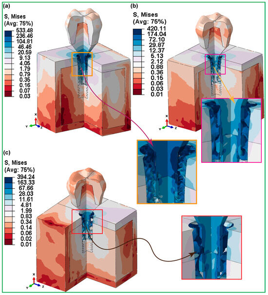 Hybrid Biomechanical Design of Dental Implants: Integrating