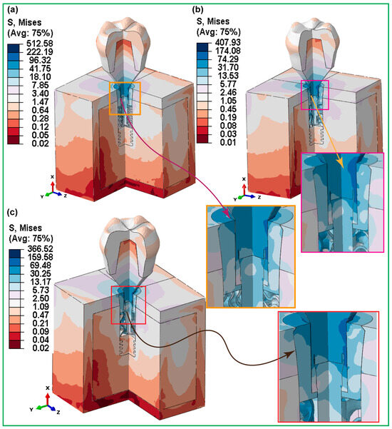 Hybrid Biomechanical Design of Dental Implants: Integrating