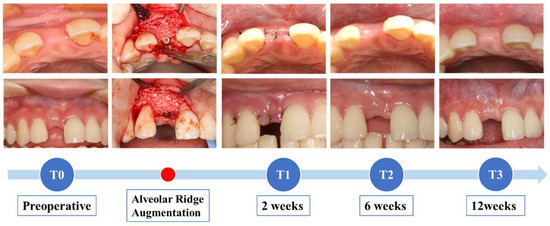 Three-Dimensional Objective Evaluation of the Changes in the Alveolar ...