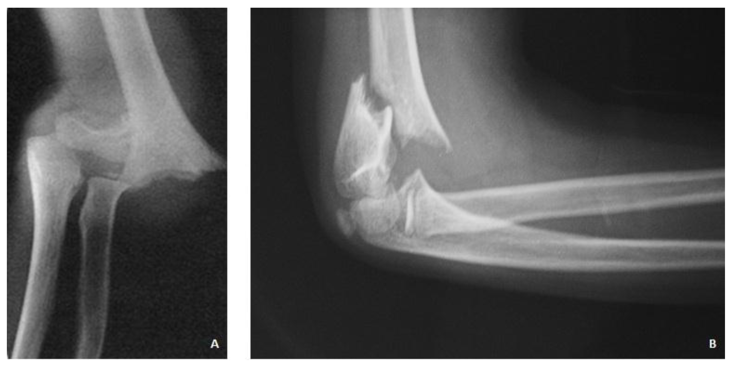 Surgical Treatment of Displaced Supracondylar Pediatric Humerus Fractures: ...