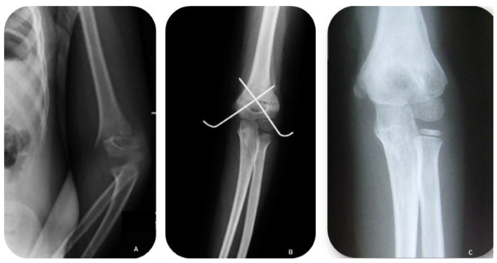 Humerus Distalis Vegenek Torese () Humerus Distalis Vegenek Torese