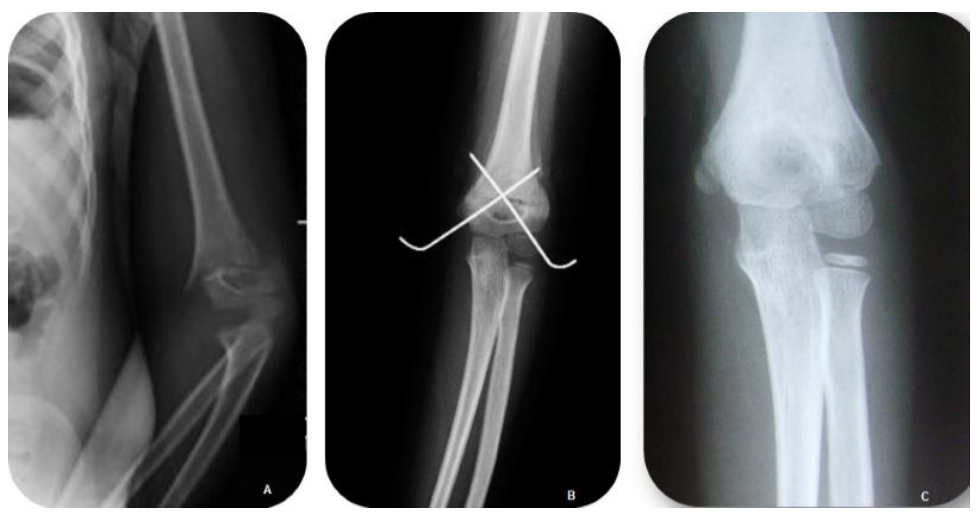 JFMK | Free Full-Text | Surgical Treatment of Displaced ...
