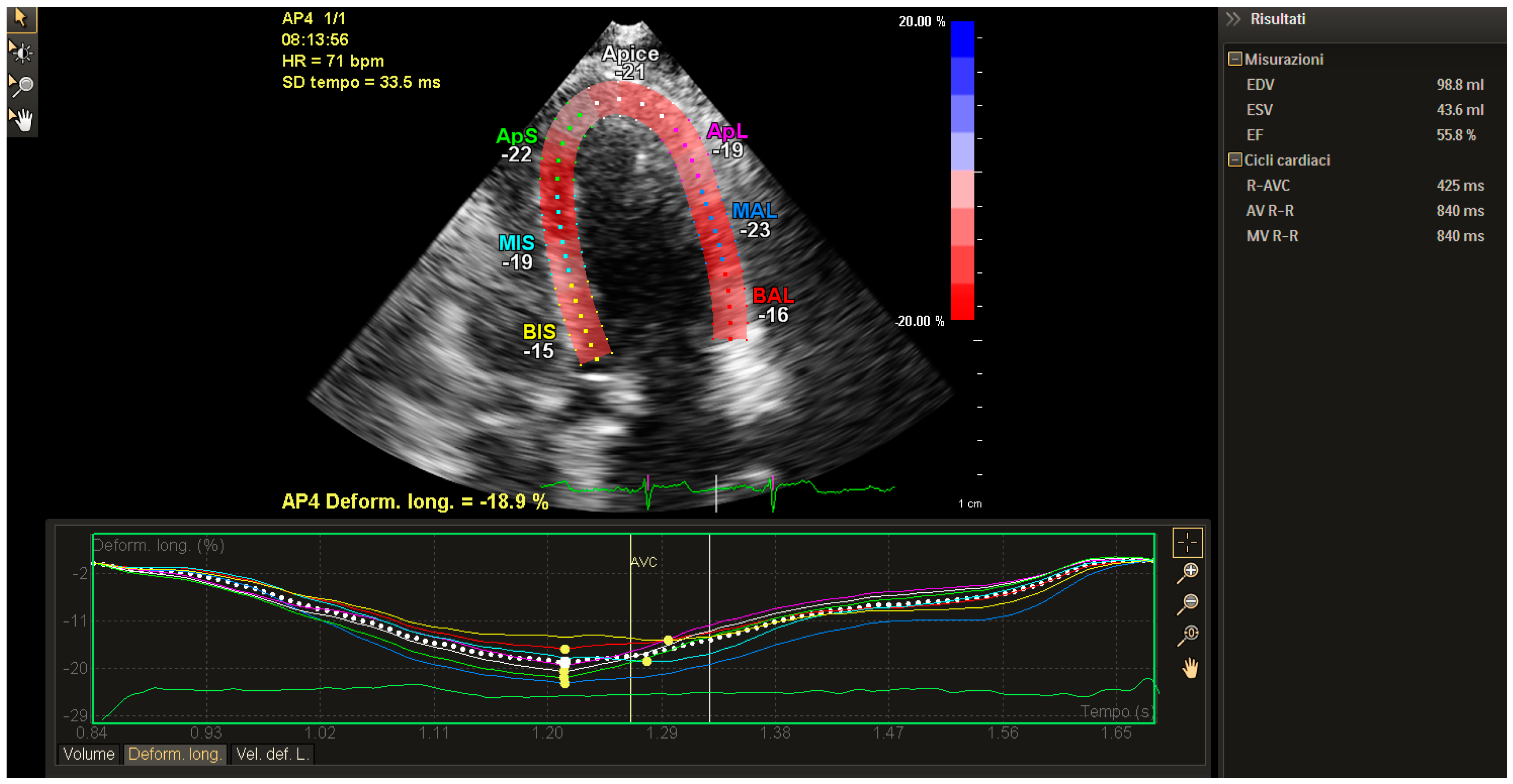 Speckle tracking echocardiography: A new approach to myocardial function