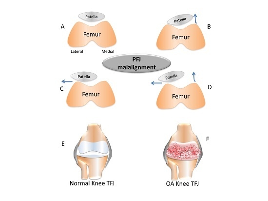 a fazett ízületek osteoarthritis)