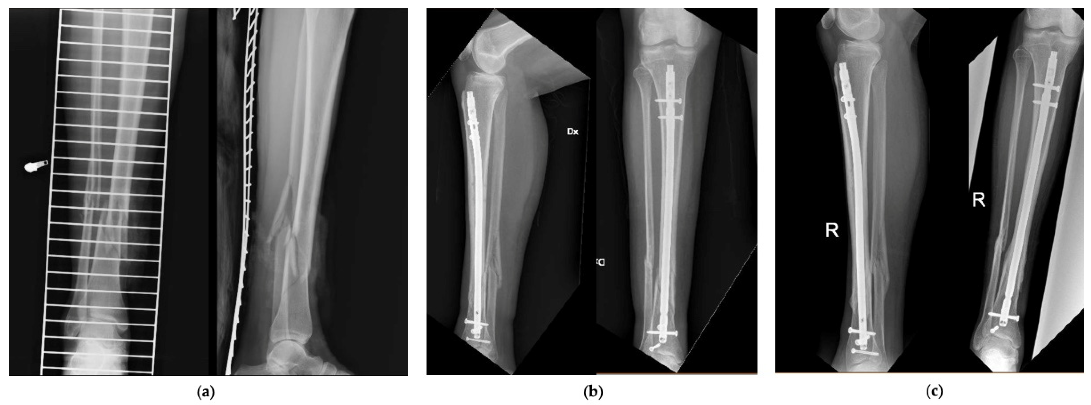 News - Selection of the entry point for Intramedullary of Tibial Fractures