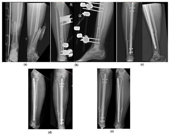 Expert Tibial Nail System (ETNS)
