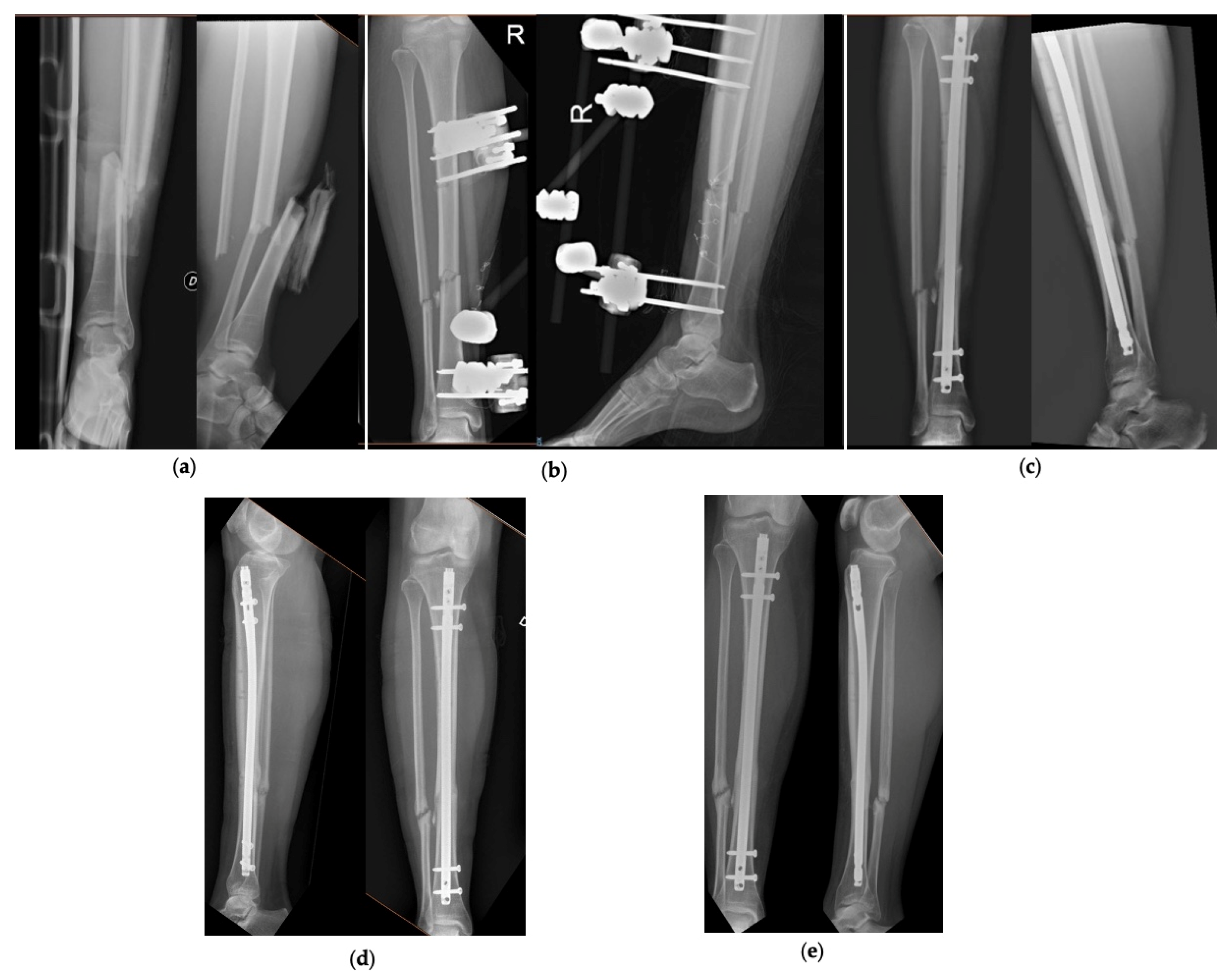 A Review of Proximal Tibia Entry Points for Intramedullary Nailing and  Validation of The Lateral Parapatellar Approach as Extra-articular |  Published in Orthopedic Reviews