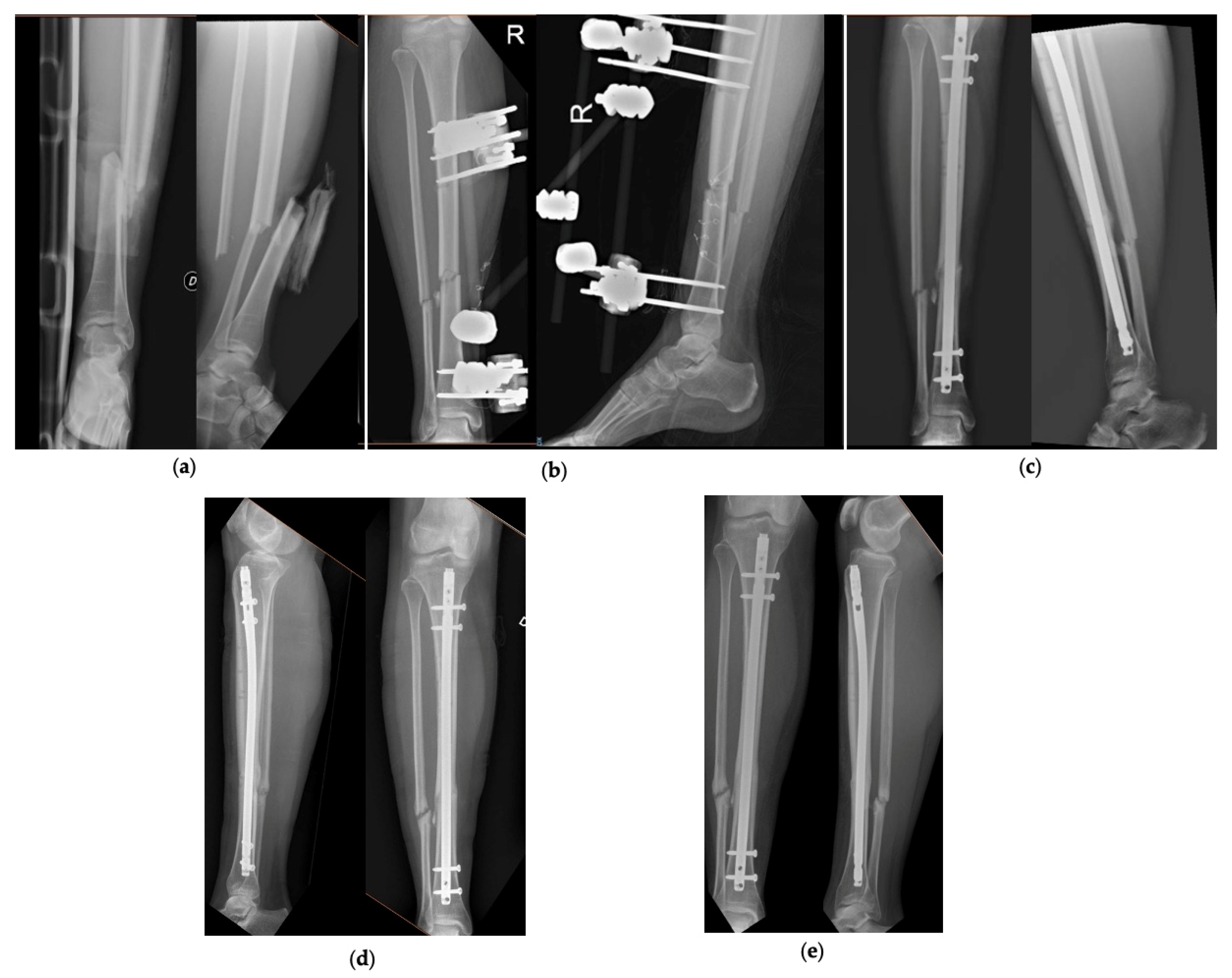 JBJI  The effectiveness of antibiotic cementcoated nails in  posttraumatic femoral and tibial osteomyelitis  comparative analysis of  custommade versus commercially available nails