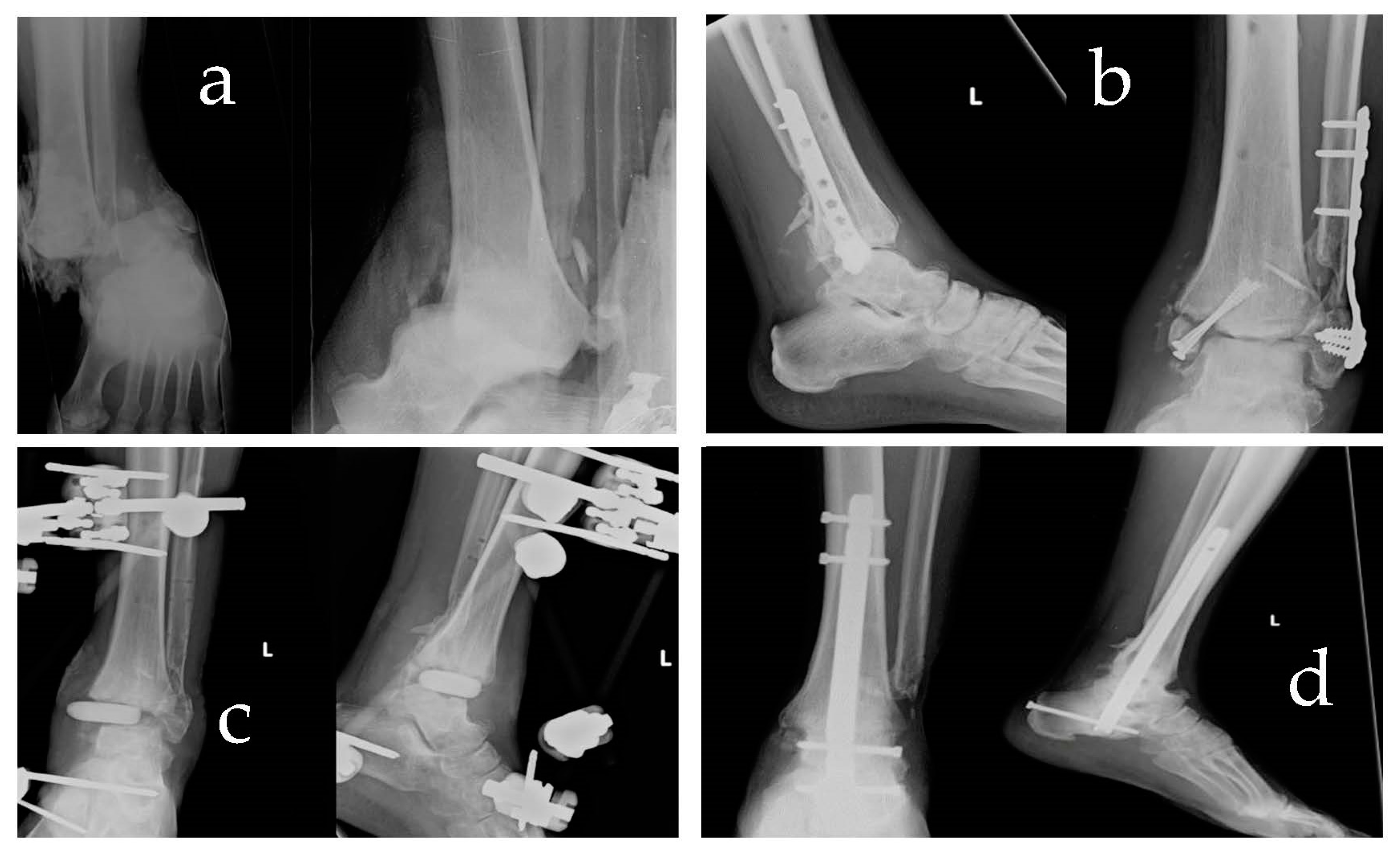 Extraction of Broken Tibial Interlock Nail with a Retrograde Hooked Guide  Wire: A Novel Surgical Technique | Journal of Orthopaedic Case Reports