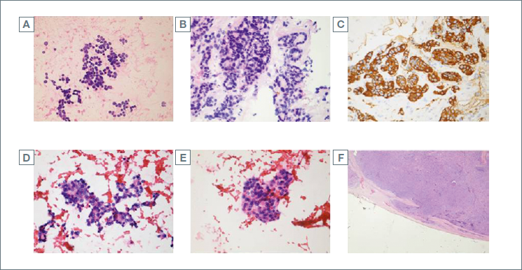 Histological confirmation of a rare case of hyperfunctioning thyroid ...