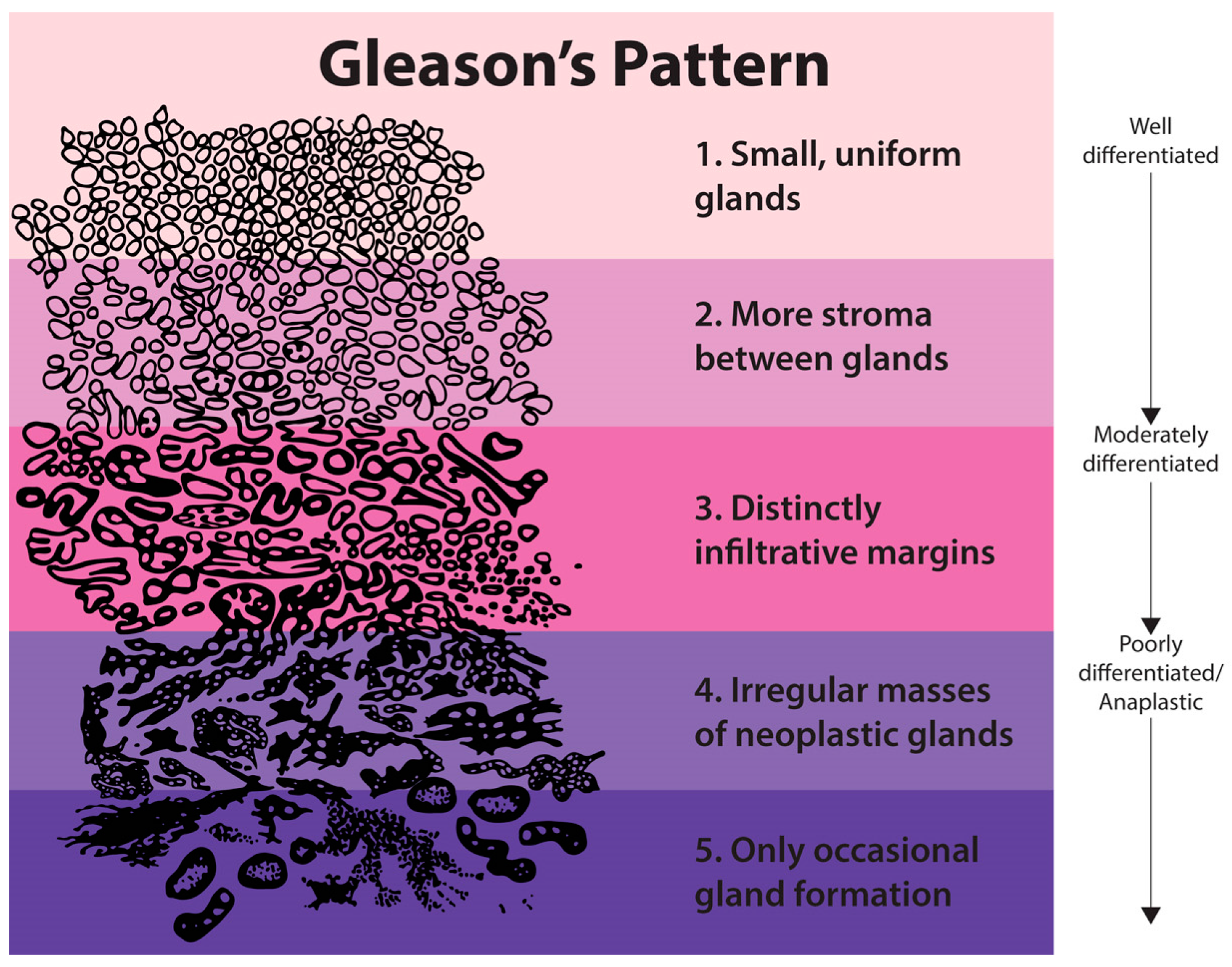 adenocarcinoma de prostata gleason 33 score 6)