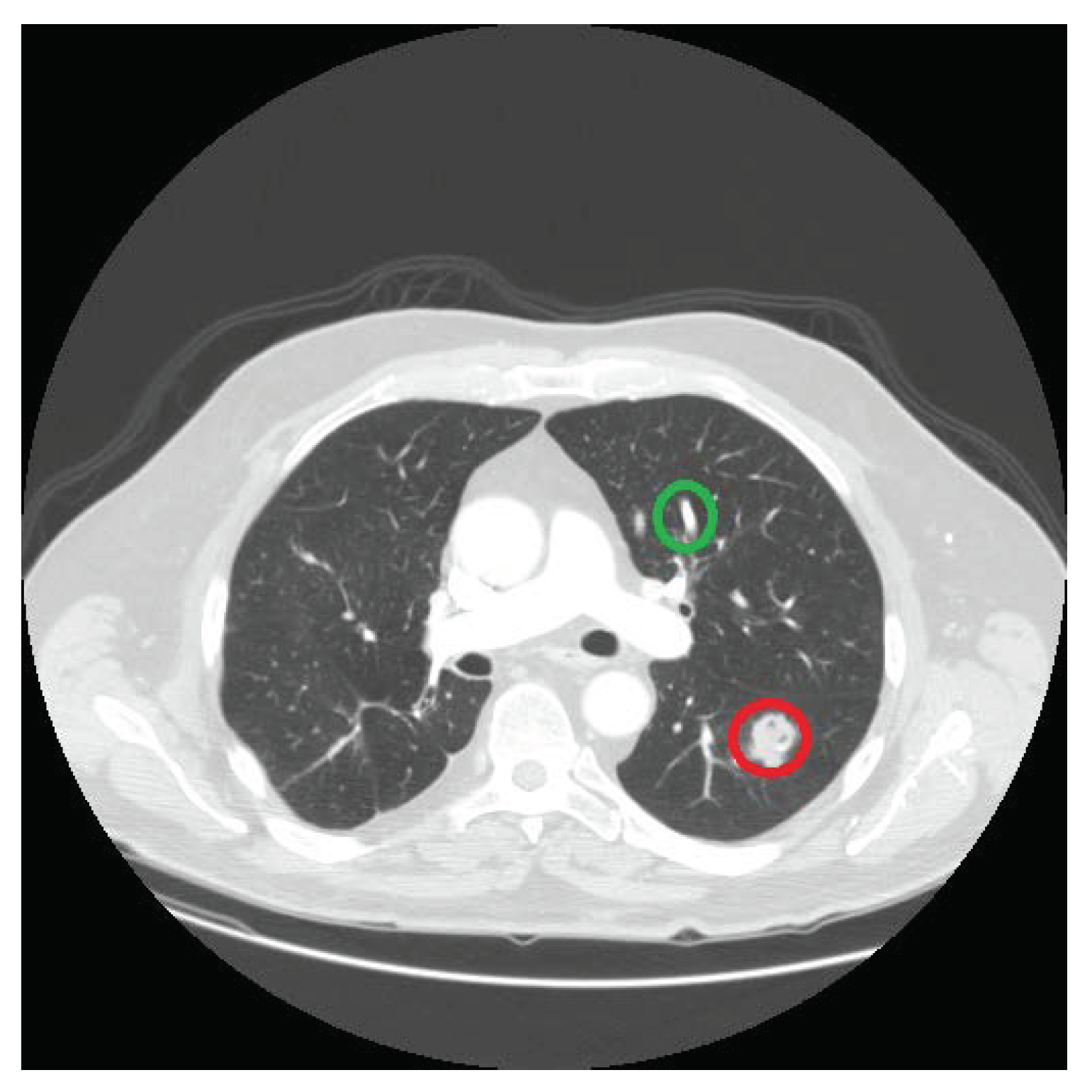 malignant mesothelioma sarcomatoid type