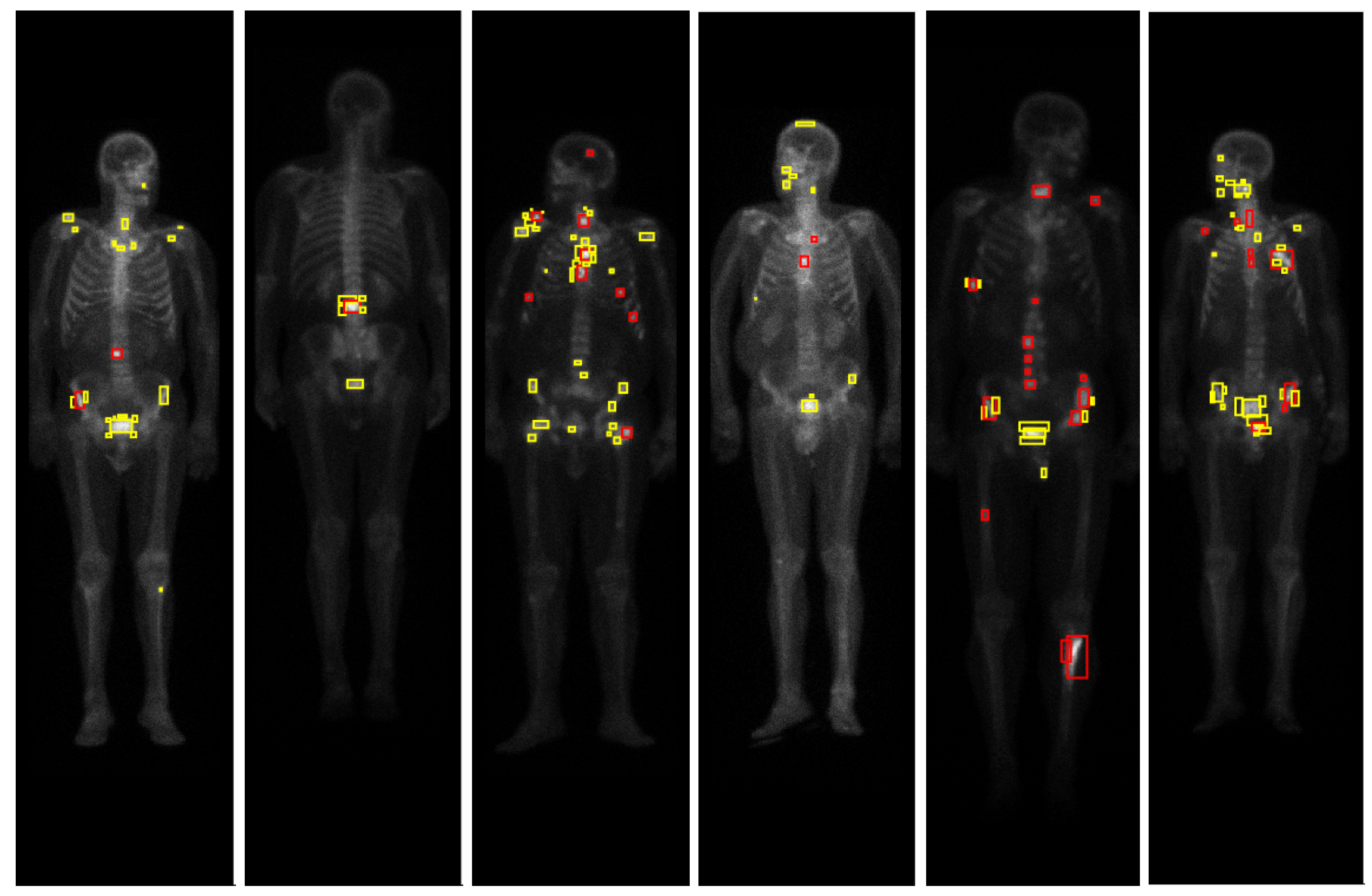 What Does A Normal Bone Scan Actually Mean? - evc3lr2