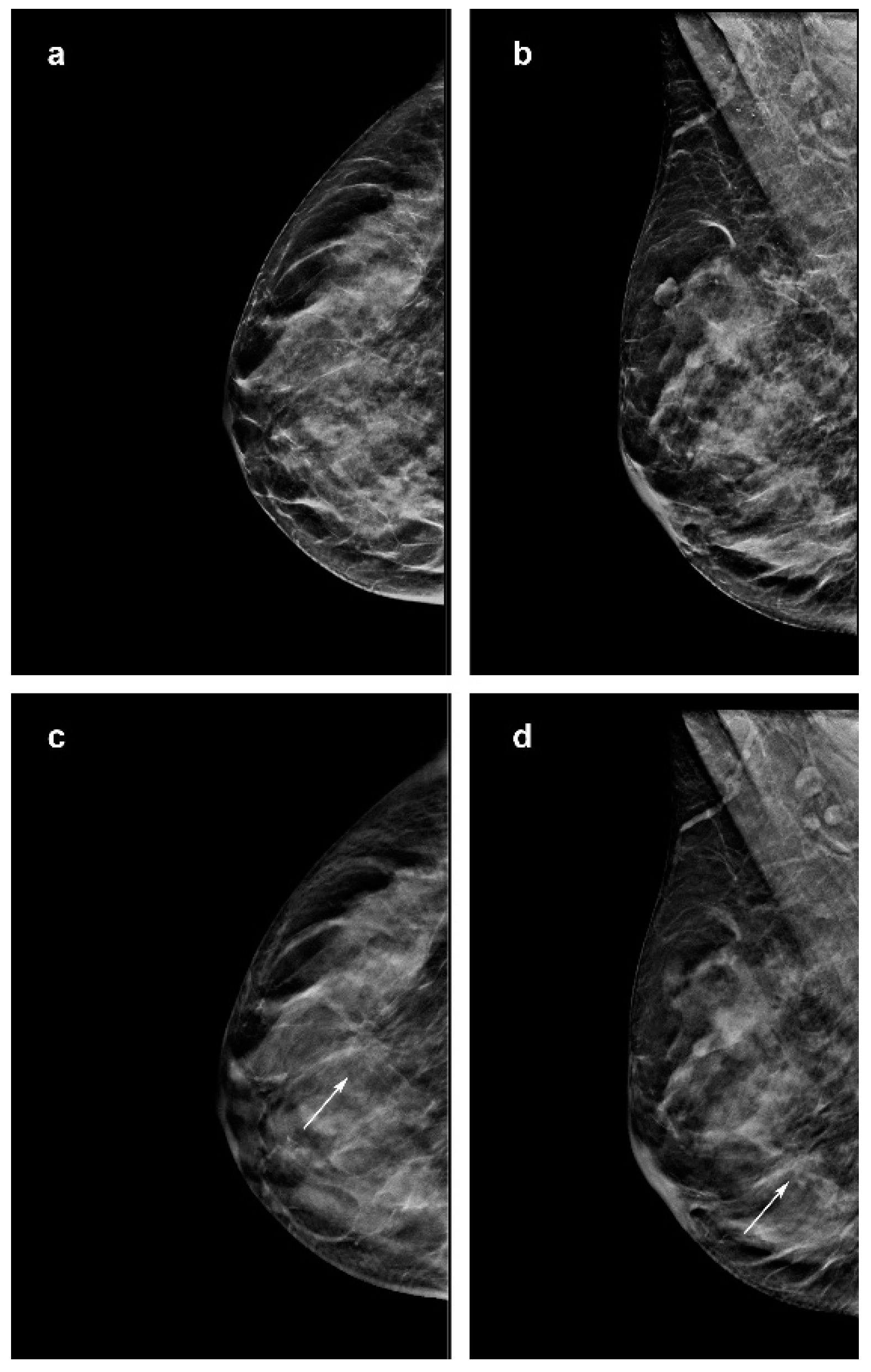 breast cancer digital mammogram