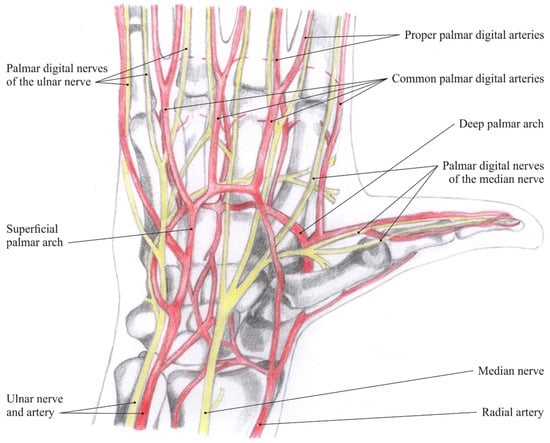 Compva: Long-term course of arteriovenous malformation of the hand
