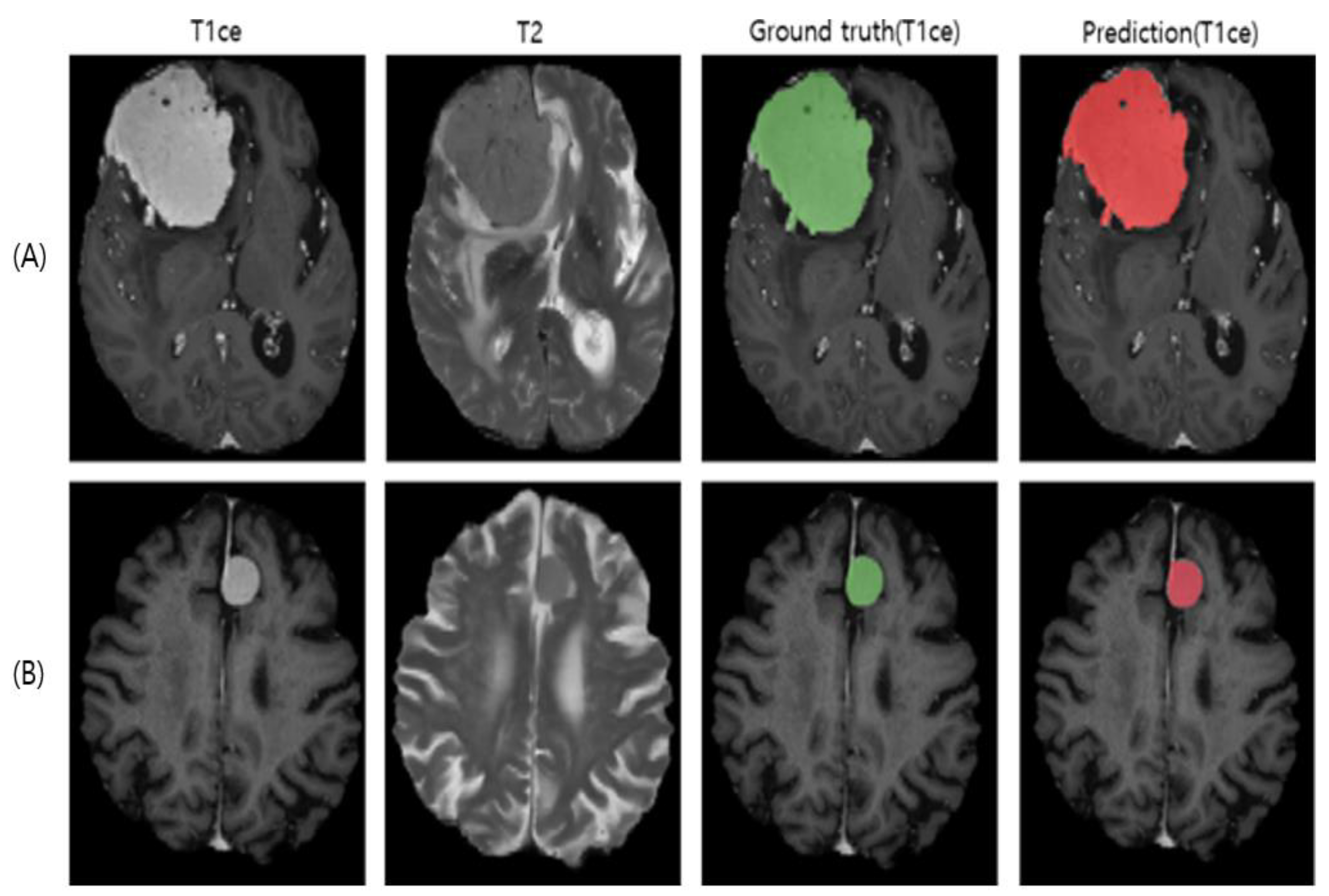Fully automated segmentation models of supratentorial meningiomas