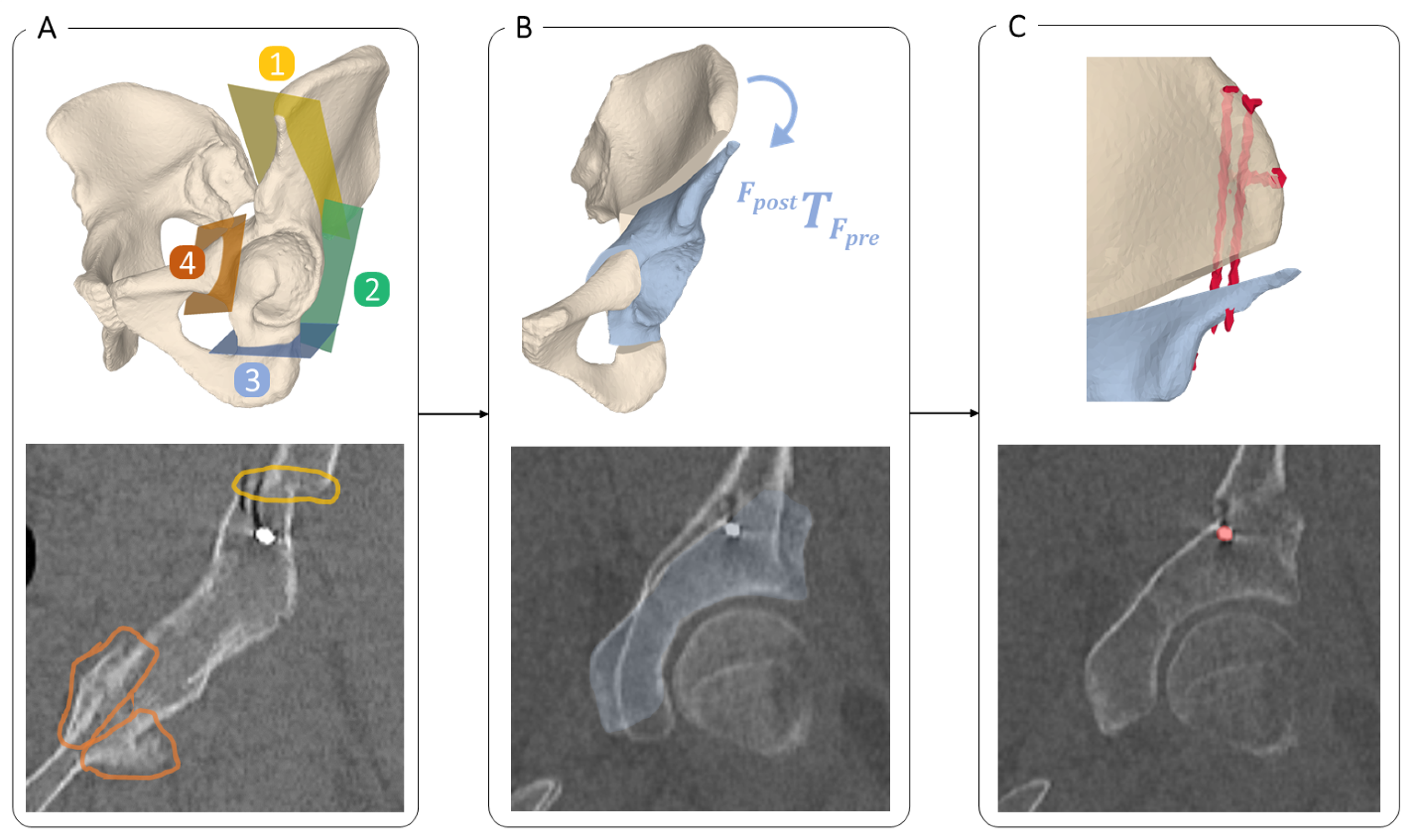 Automatic 3D Postoperative Evaluation of Complex Orthopaedic