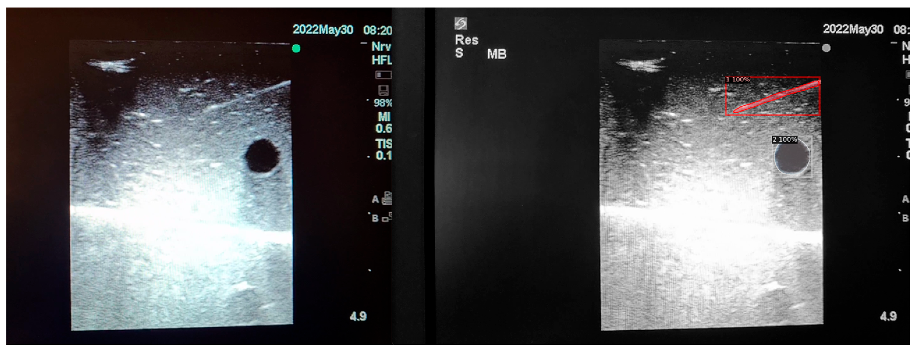 Leveraging Datature Nexus for Tumor and Anomaly Detection in Medical Scans  : Part I