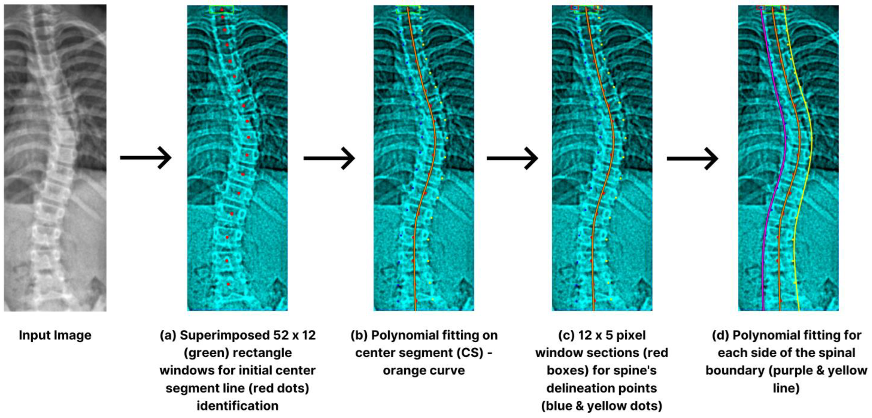 J. Imaging | Free Full-Text | SCOLIONET: An Automated Scoliosis Cobb Angle  Quantification Using Enhanced X-ray Images and Deep Learning Models
