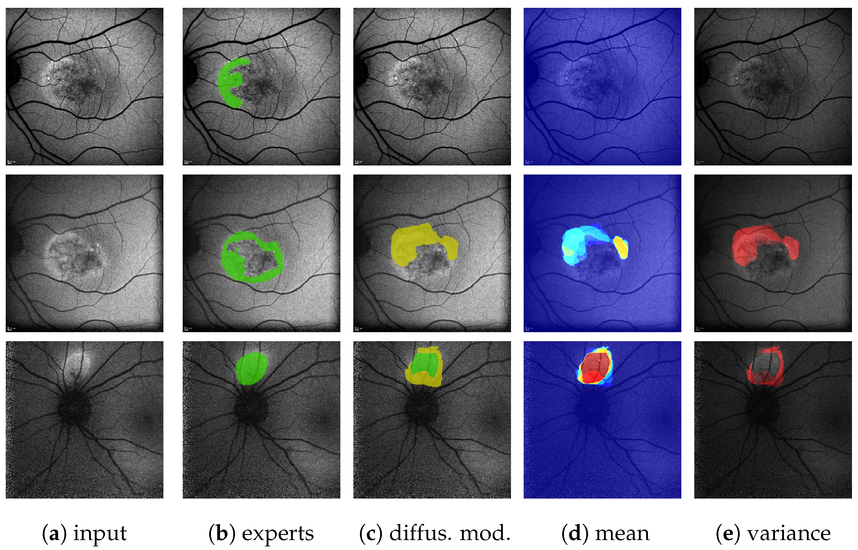 lsm.jpg4.us | imagesize: isn-001 When Two Eyes Don&rsquo;t Suffice&mdash;Learning Difficult  Hyperfluorescence Segmentations in Retinal Fundus Autofluorescence Images  via Ensemble Learning