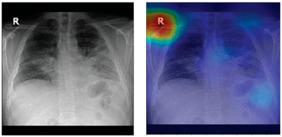 Deep Learning for Pneumonia Detection in Chest X-ray Images: A ...