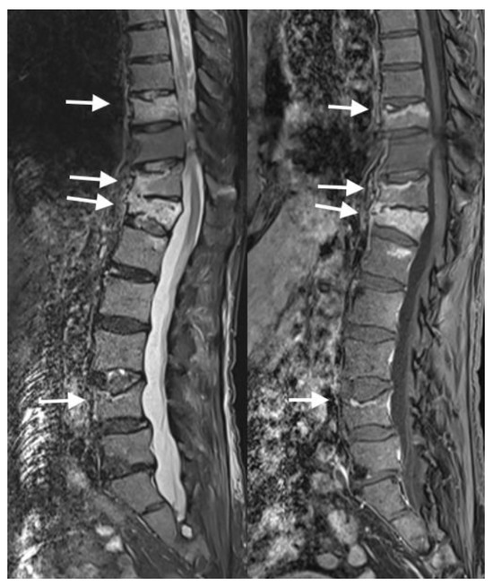 Radiological Diagnosis and Advances in Imaging of Vertebral