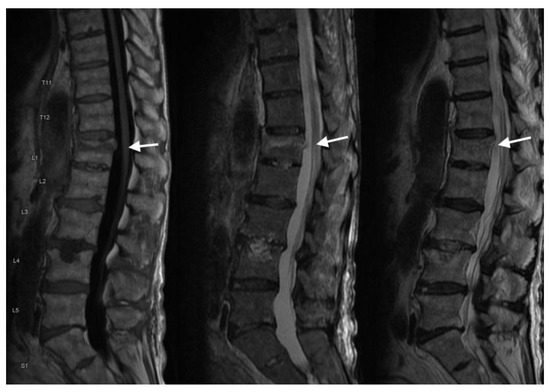 Radiological Diagnosis and Advances in Imaging of Vertebral