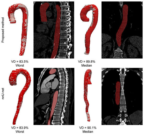 The Robust Vessel Segmentation and Centerline Extraction: One-Stage ...