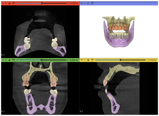 Development of Semi-Automatic Dental Image Segmentation Workflows with ...