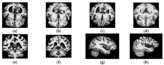 A Dual Stream Deep Learning Framework for Alzheimer’s Disease Detection ...