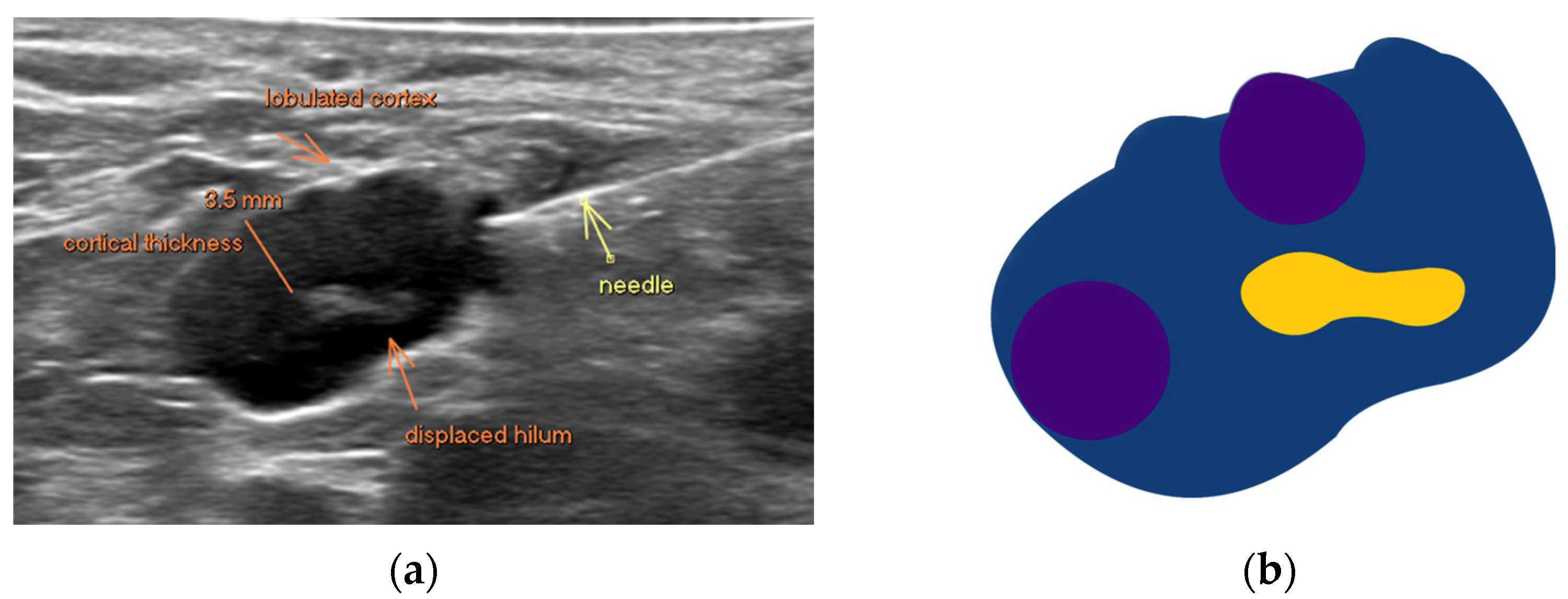 JMP | Free Full-Text | The Value of Fine Needle Aspiration Biopsy in ...