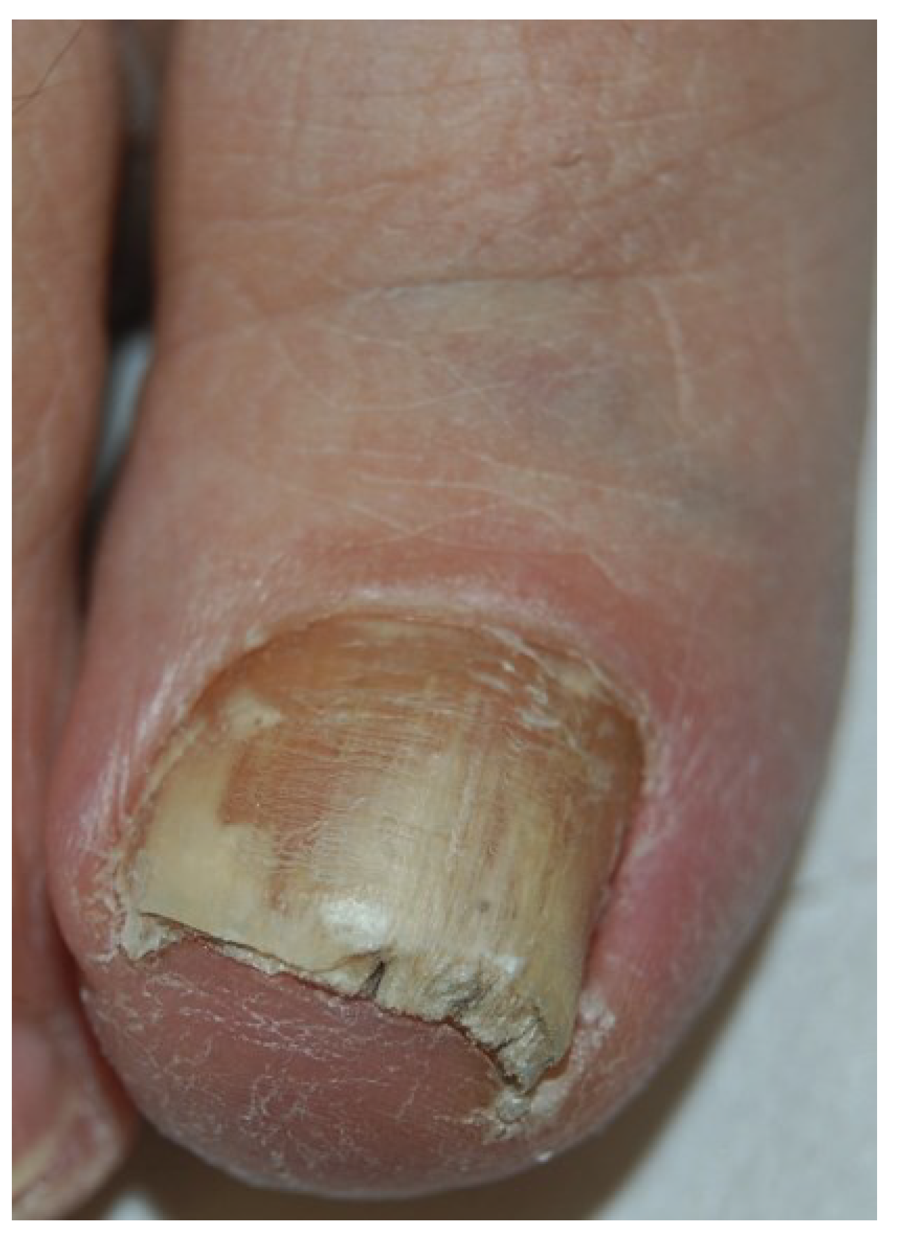 Topical Treatments Options for Toenail Fungus