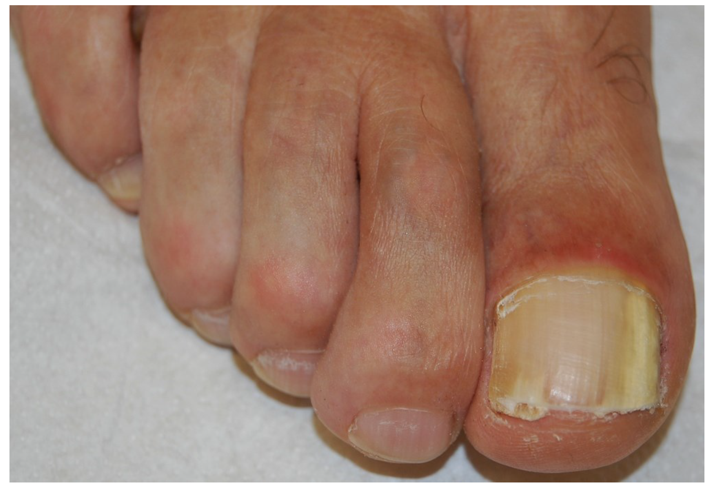 Elmicrobiologist - 👉 Onychomycosis (tinea unguium) Onychomycosis