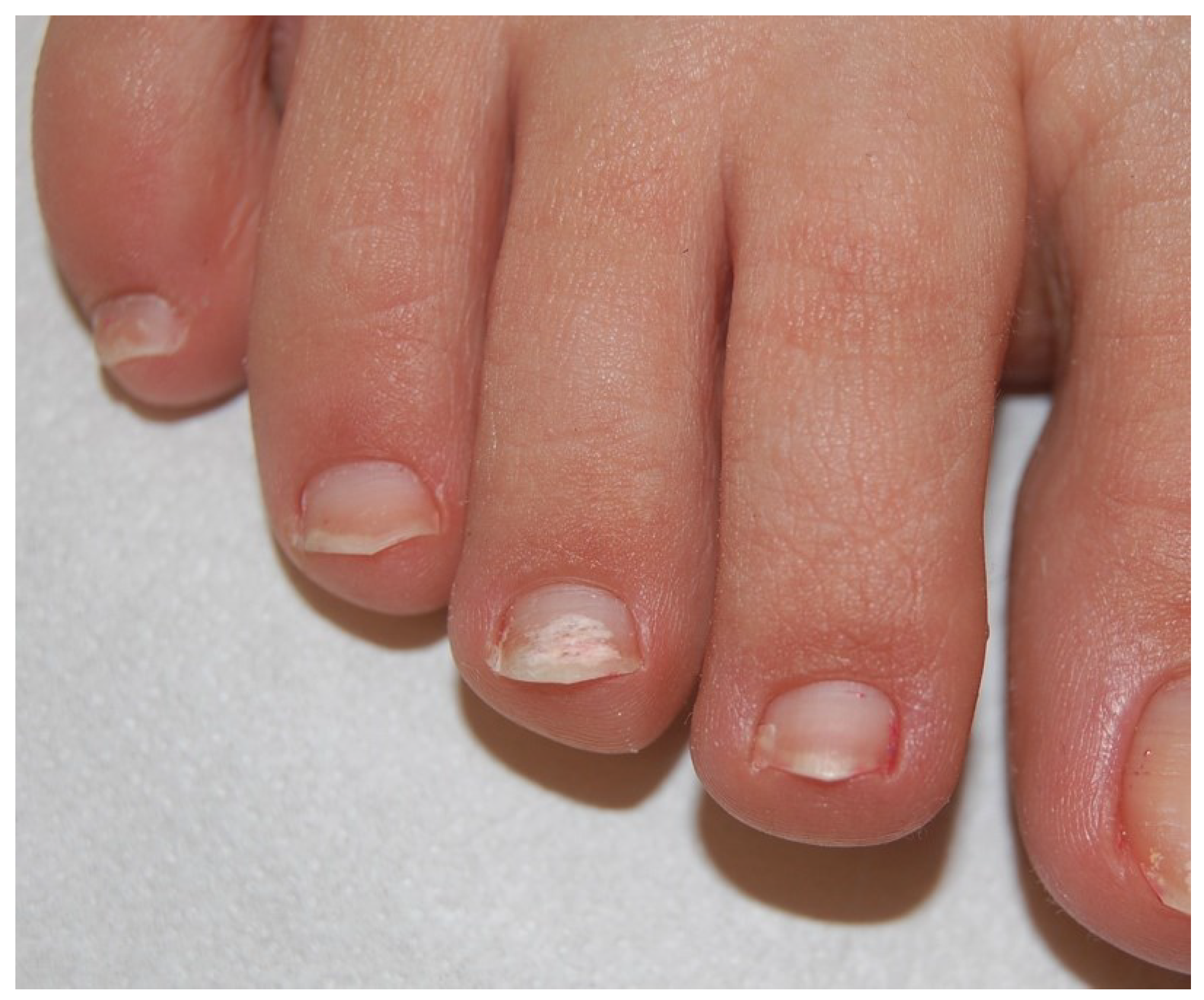 Clinical tools for successful treatment of onychomycosis: a narrative  review   SpringerLink