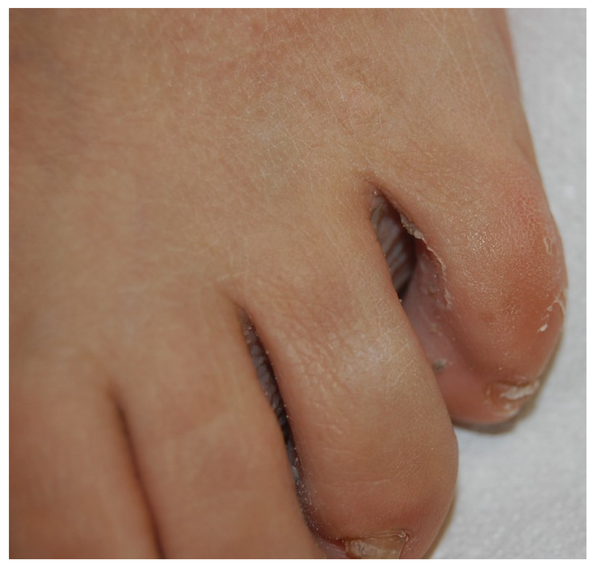 Onychomycosis due to molds, presenting the typical periungual... | Download  Scientific Diagram